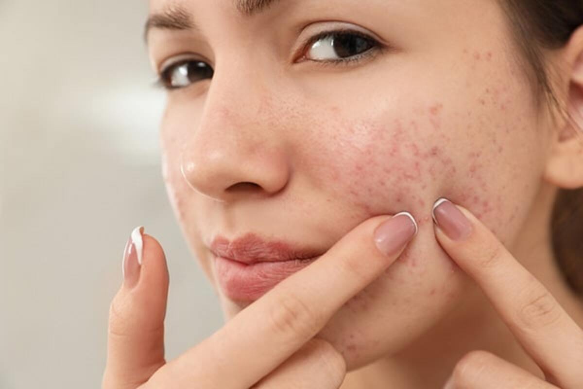 remedies-to-cure-acne