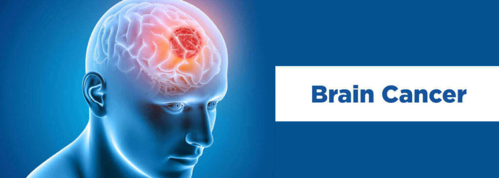 Understanding Brain Cancer Causes Symptoms And Treatm