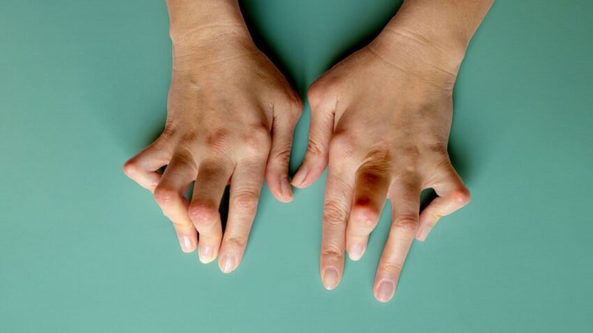 How to cure rheumatoid arthritis permanently